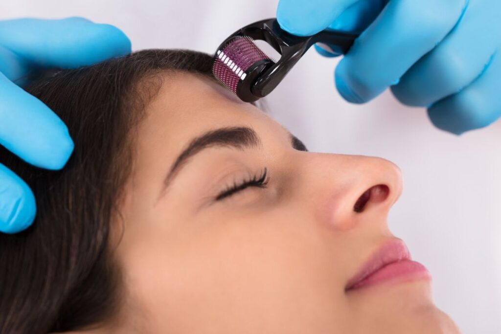 Microneedling with prp treatment with client