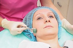 a woman receiving microneedling with PRP skin treatment which is often referred to as a vampire facial