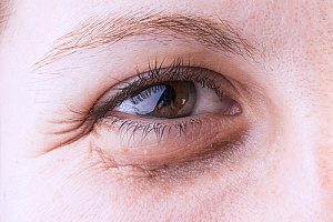 dark circles under eyes that will receive Restylane treatment in order to cure them