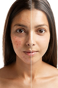 before and after picture from microneedling