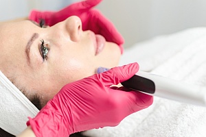 woman getting microneedling done to her face