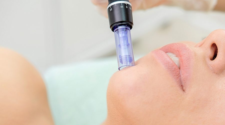 woman laying down getting microneedling done to her face