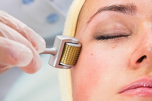 woman using derma roller during microneedling treatment