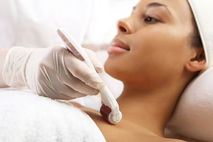 woman happy with professional microneedling