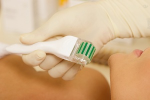 home microneedling using a roller