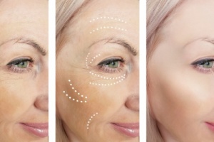 woman who received radiesse face filler for wrinkles