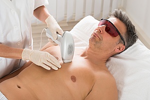 a man receiving laser hair removal on his chest