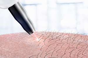 Laser hair removal closeup