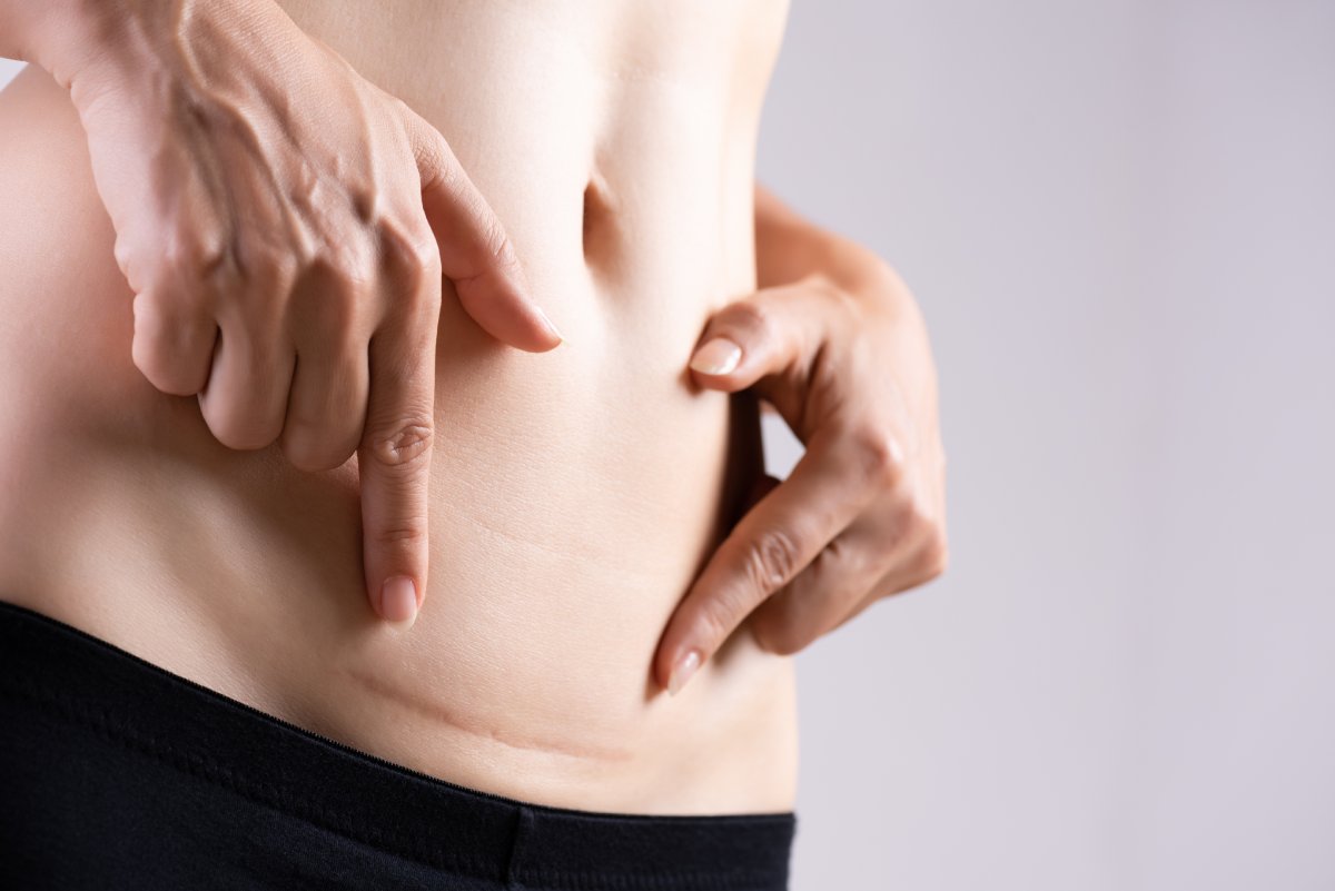 Woman showing c-section scar before her scar revision tattoo treatment